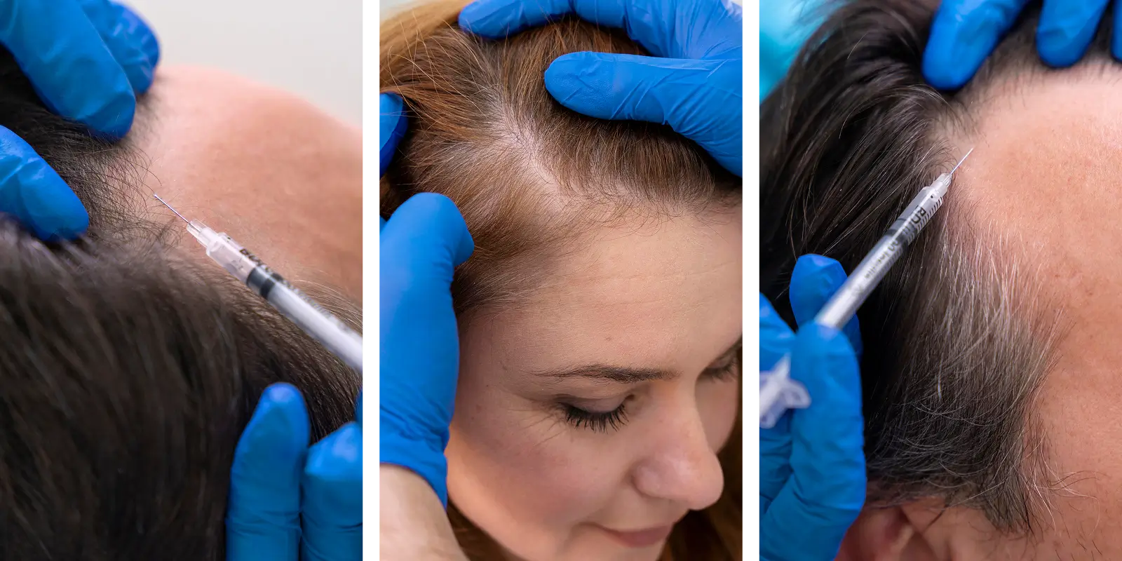 A graphic or visual showing the PRP (yellow/amber) rich in platelets in a tube.