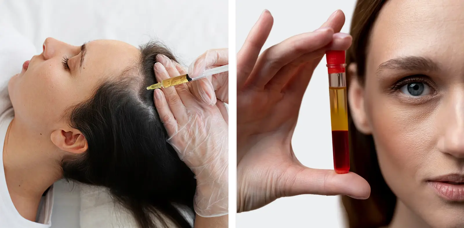 Professional performing Platelet-Rich Plasma (PRP) injections for hair restoration at West Spa Medical Aesthetics DDO.